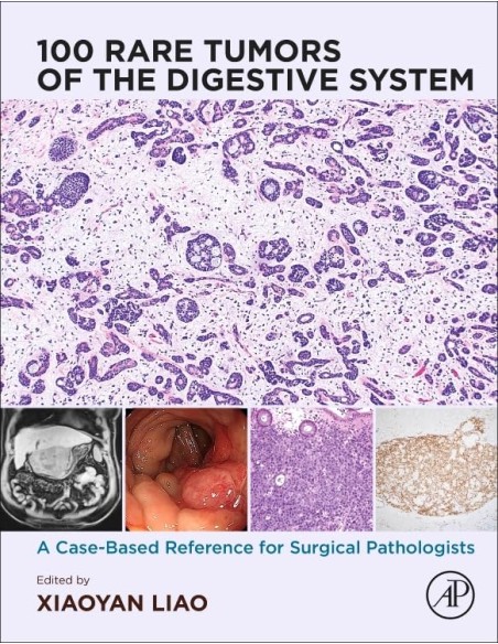 100 rare tumors of the digestive system
