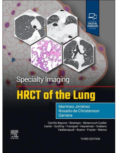 Specialty imaging hrct of the lung