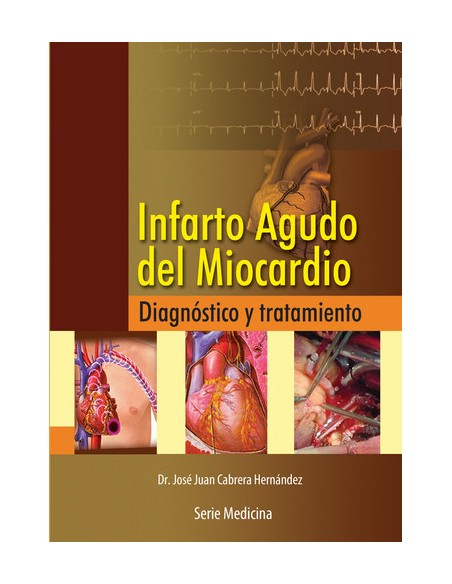 INFARTO AGUDO DEL MIOCARDIO