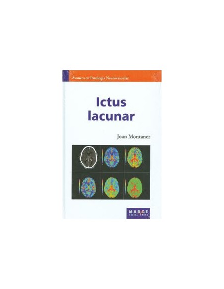 ICTUS LACUNAR