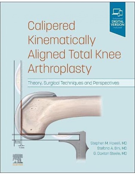 Calipered kinematically aligned total knee arthroplasty