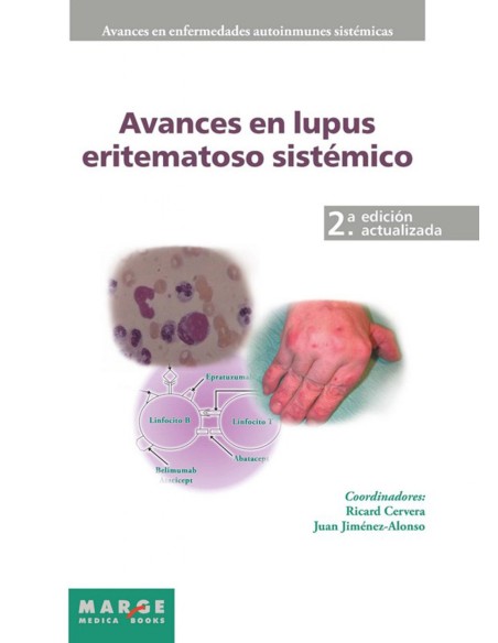 Avances en lupus eritematoso sistemico