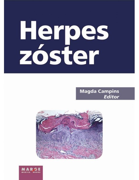 Herspes Zoster